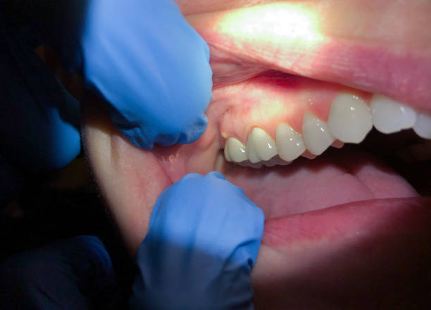 Best Emergency Dental Care for Broken or Chipped Teeth in Muscoda, WI